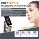 RF-Mikronadelung vor und nach der Behandlung, Radiofrequenz-Mikronadelung, Funktioniert Mikronadelung, wie tief reicht Mikronadelung bei tiefen Aknenarben, Vorteile der Mikronadelung