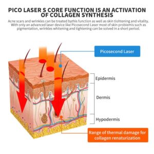 Legendäre Tattooentfernung mit Pikosekundenlaser. Tut das Laser-Tattoo weh und wie läuft die Tattooentfernung mit dem Laser ab?