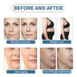 Faltenentfernung Gewichtsverlust Anti-Aging Gesichtslifting & Straffung
