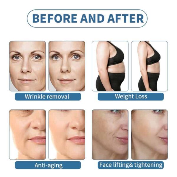 BCHYQ045 Faltenentfernung Gewichtsverlust Anti-Aging Gesichtslifting & Straffung