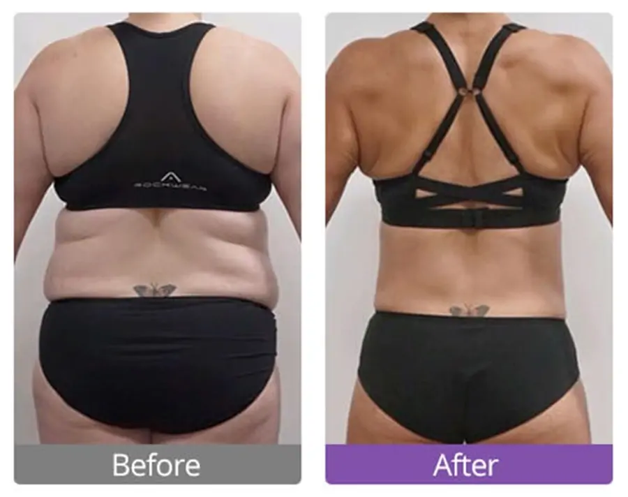 Resultados antes y después de la cavitación ultrasónica que funcionan en la reducción de grasa de la espalda.