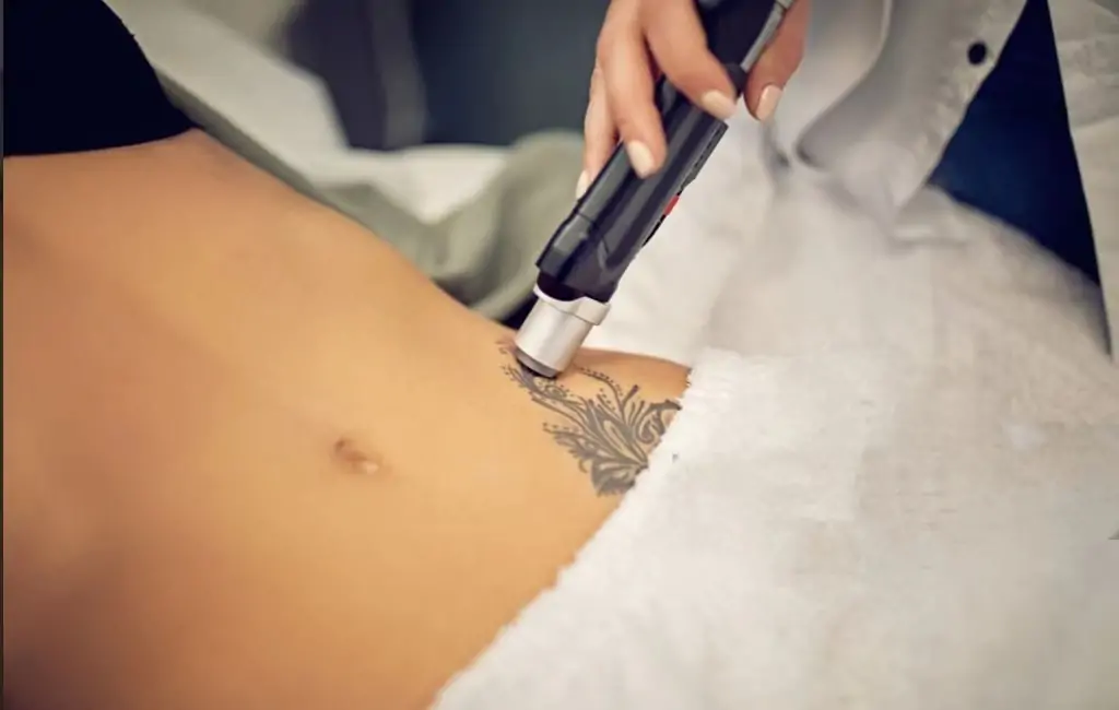 ¿Cuál es la última tecnología de eliminación de tatuajes?