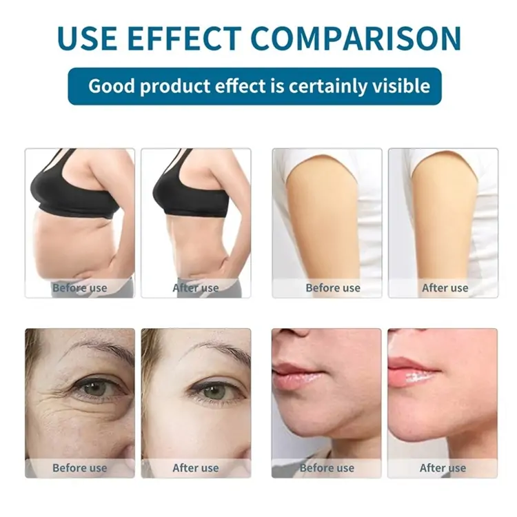 ultrasonic cavitation RF before and after-shefmon