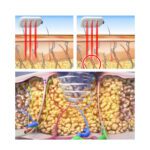 lipo laser rf radio frequency ems muscle stimulator