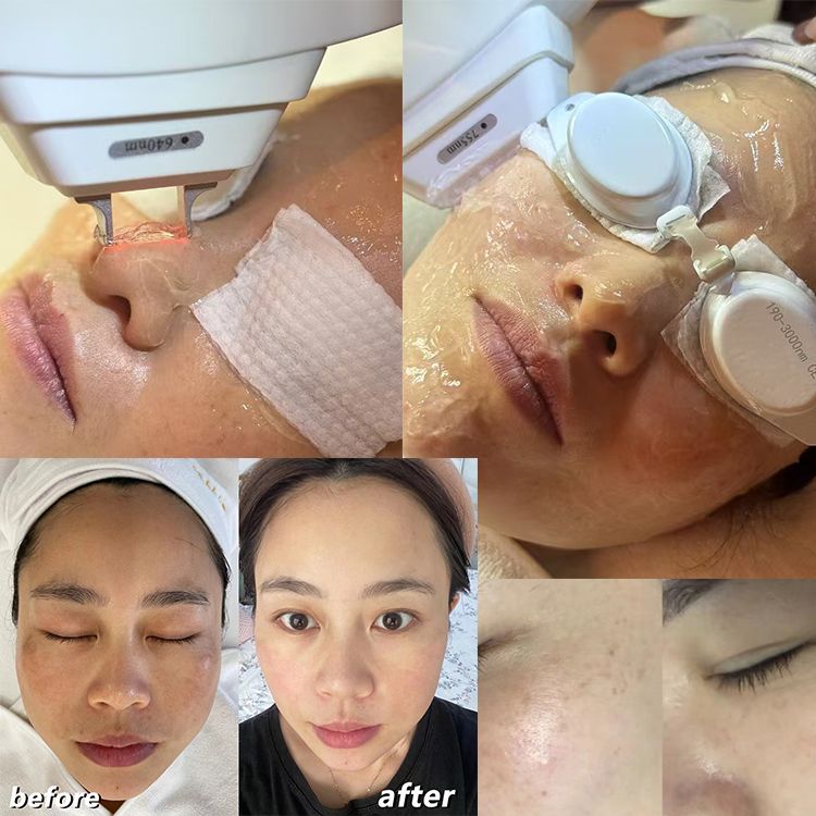 Zelluläre Licht-DPL-Photofacial-Haarentfernung