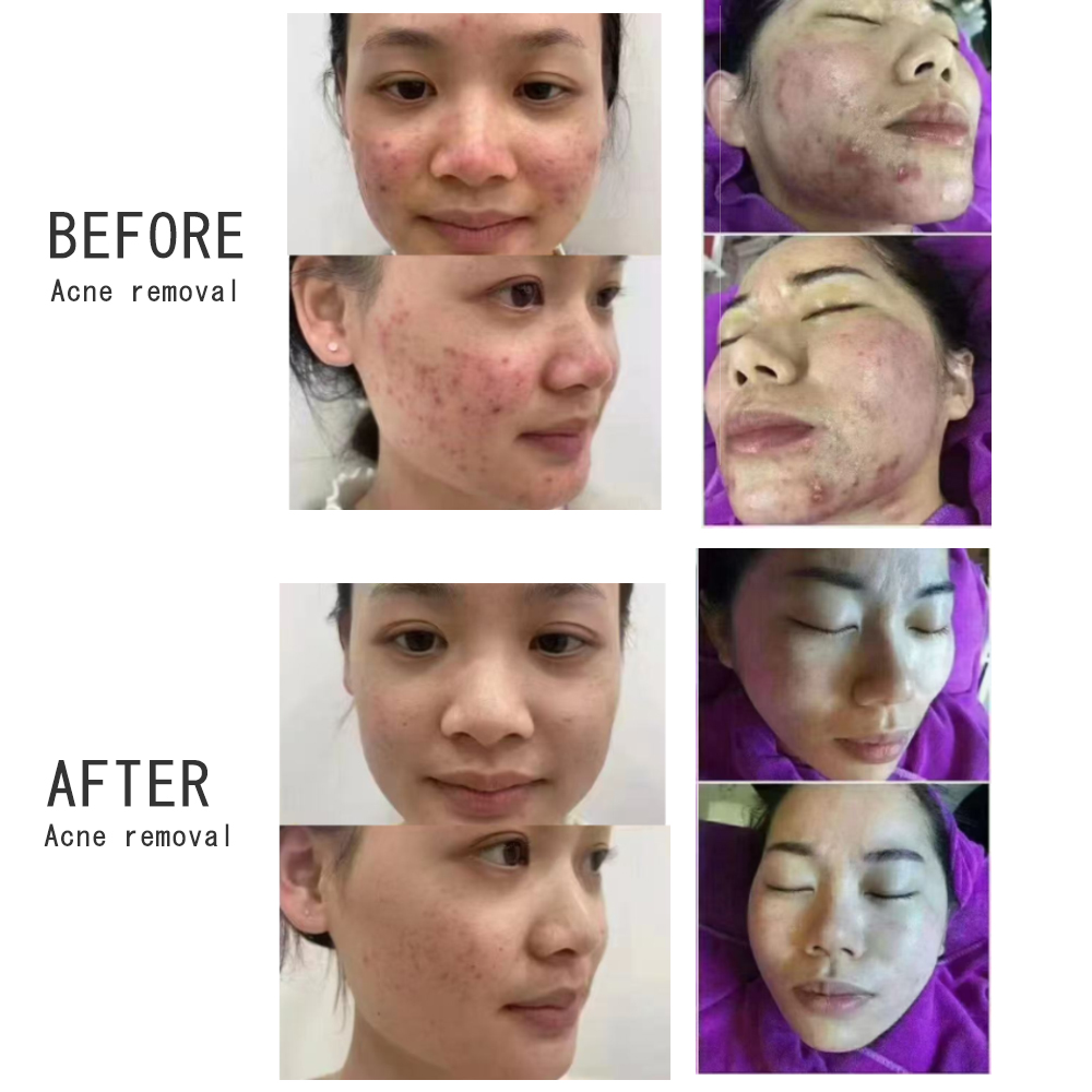 Professional Cold Plasma Facial Machine for Acne Care and Skin Renewal - shefmon