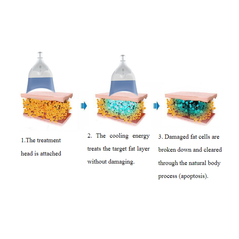 Good Candidate for Cryolipolysis 360 Fat Freezing Treatment - shefmon
