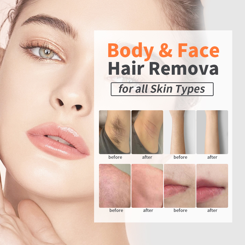 Epilazione laser - shefmon