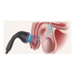 SW35 FSWT Focused Shockwave Therapy Equipment with Multi-Depth Probes for Deep Tissue - Image 4
